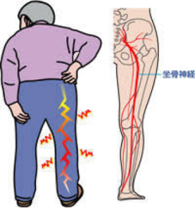 「坐骨神経痛」の画像検索結果